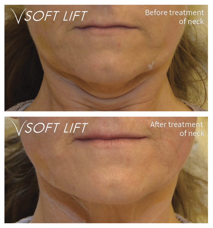 Before and after treatment of neck